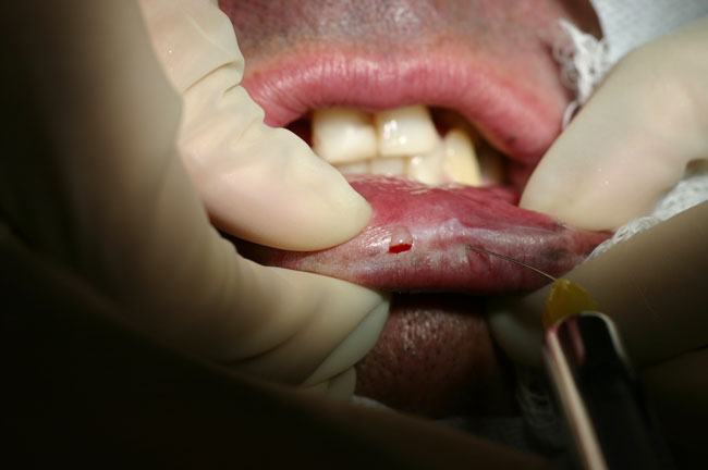 Dentistas da São Leopoldo Mandic avaliam casos de queilite actínica (foto: divulgação) Dentistas da São Leopoldo Mandic avaliam casos de queilite actínica (foto: divulgação)